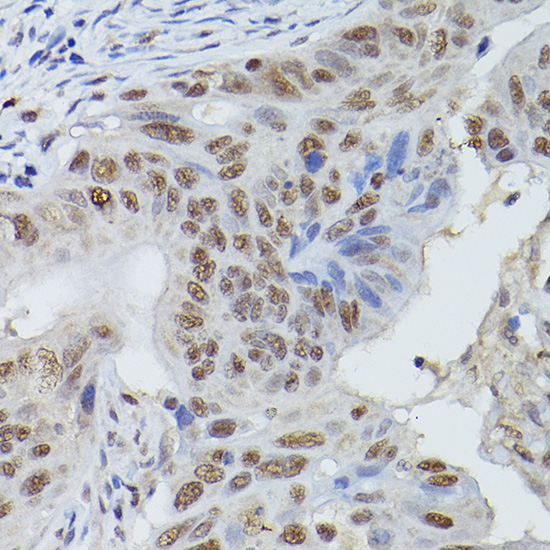 Immunohistochemistry of paraffin-embedded human colon carcinoma using MRE11 Polyclonal Antibody at dilution of 1:50 (40x lens).Perform high pressure antigen retrieval with 10 mM citrate buffer pH 6.0 before commencing with IHC staining protocol.