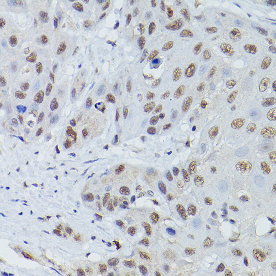 Immunohistochemistry of paraffin-embedded human esophageal cancer using MRE11 Polyclonal Antibody at dilution of 1:50 (40x lens).Perform high pressure antigen retrieval with 10 mM citrate buffer pH 6.0 before commencing with IHC staining protocol.