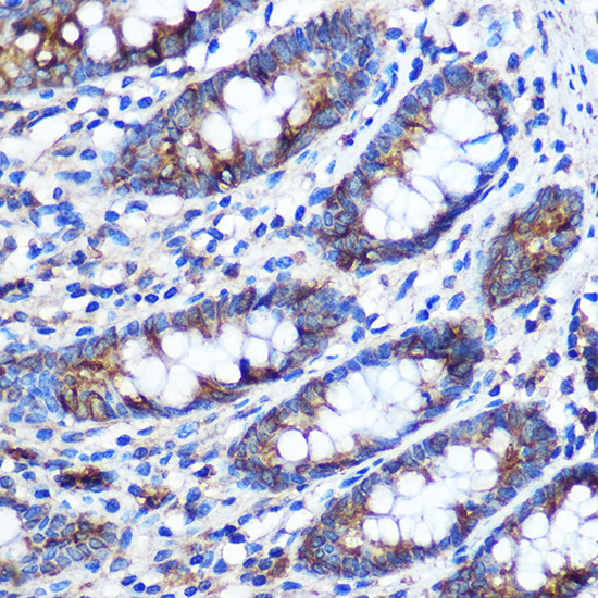 Immunohistochemistry of paraffin-embedded Human colon using STAT4 Polyclonal Antibody at dilution of 1:100 (40x lens).Perform microwave antigen retrieval with 10 mM PBS buffer pH 7.2 before commencing with IHC staining protocol.