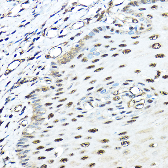 Immunohistochemistry of paraffin-embedded human esophageal using VCP Polyclonal Antibody at dilution of 1:100 (40x lens).Perform high pressure antigen retrieval with 10 mM citrate buffer pH 6.0 before commencing with IHC staining protocol.