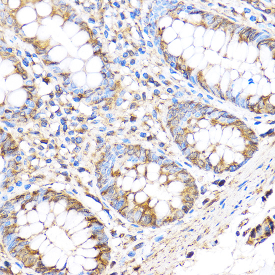 Immunohistochemistry of paraffin-embedded Human colon using MMP17 Polyclonal Antibody at dilution of 1:100 (40x lens).Perform microwave antigen retrieval with 10 mM PBS buffer pH 7.2 before commencing with IHC staining protocol.