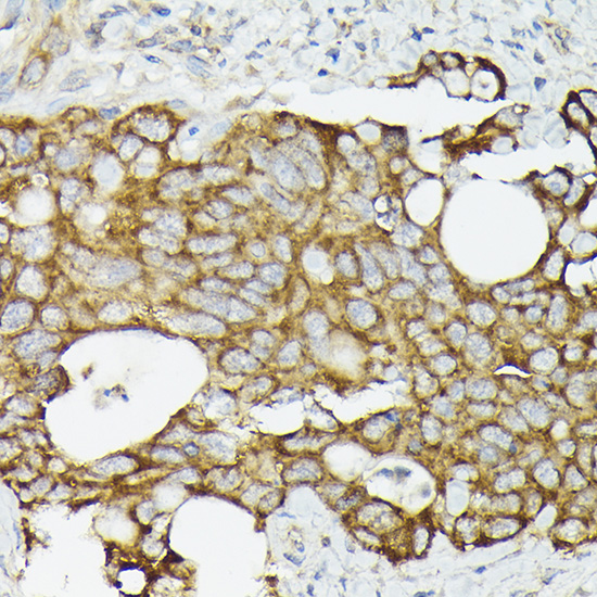 Immunohistochemistry of paraffin-embedded human colon carcinoma using TRAF7 Polyclonal Antibody at dilution of 1:50 (40x lens).Perform high pressure antigen retrieval with 10 mM citrate buffer pH 6.0 before commencing with IHC staining protocol.