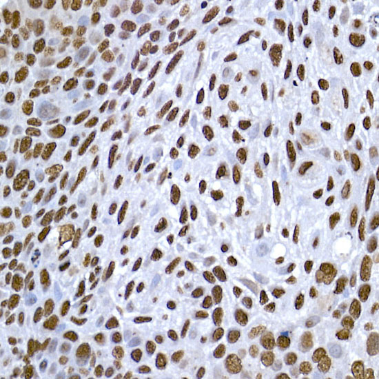 Immunohistochemistry of paraffin-embedded human esophageal cancer using HIST1H1C Polyclonal Antibody atdilution of 1:200 (40x lens).Perform high pressure antigen retrieval with 10 mM citrate buffer pH 6.0 before commencing with IHC staining protocol.