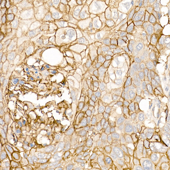 Immunohistochemistry of paraffin-embedded human lung squamous carcinoma tissue using CD141/Thrombomodulin Polyclonal Antibody at dilution of 1:20 (40x lens).Perform high pressure antigen retrieval with 10 mM citrate buffer pH 6.0 before commencing with IHC staining protocol.