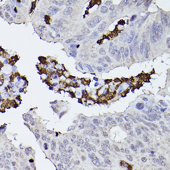 Immunohistochemistry of paraffin-embedded human colon carcinoma using CFP Polyclonal Antibody at dilution of 1:50 (40x lens).Perform high pressure antigen retrieval with 10 mM citrate buffer pH 6.0 before commencing with IHC staining protocol.