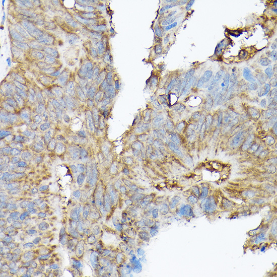 Immunohistochemistry of paraffin-embedded human colon carcinoma using SLC8A1 Polyclonal Antibody at dilution of 1:100 (40x lens).Perform high pressure antigen retrieval with 10 mM citrate buffer pH 6.0 before commencing with IHC staining protocol.