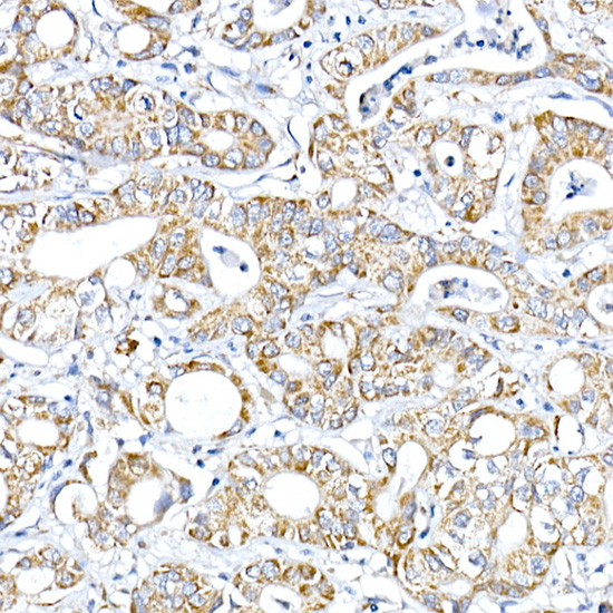 Immunohistochemistry of paraffin-embedded human liver cancer using PTPIP51/RMDN3 Polyclonal Antibody at dilution of 1:100 (40x lens).Perform high pressure antigen retrieval with 10 mM citrate buffer pH 6.0 before commencing with IHC staining protocol.