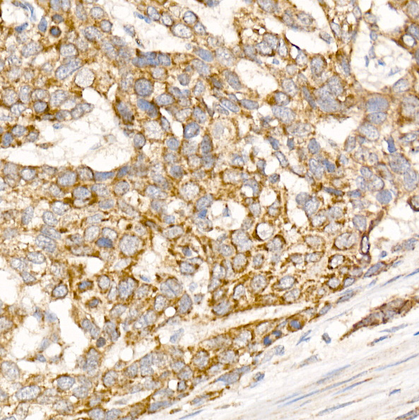 Immunohistochemistry of paraffin-embedded human esophageal cancer using Glycerol kinase Polyclonal Antibody at dilution of 1:100 (40x lens).Perform high pressure antigen retrieval with 10 mM citrate buffer pH 6.0 before commencing with IHC staining protocol.