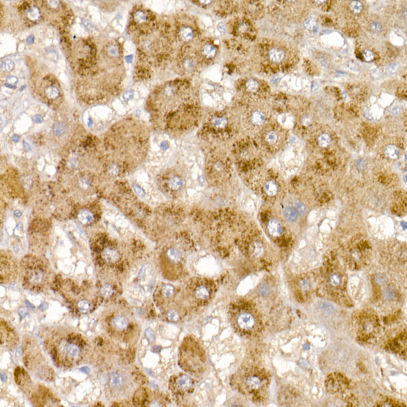 Immunohistochemistry of paraffin-embedded human liver using Glycerol kinase Polyclonal Antibody at dilution of 1:100 (40x lens).Perform high pressure antigen retrieval with 10 mM citrate buffer pH 6.0 before commencing with IHC staining protocol.