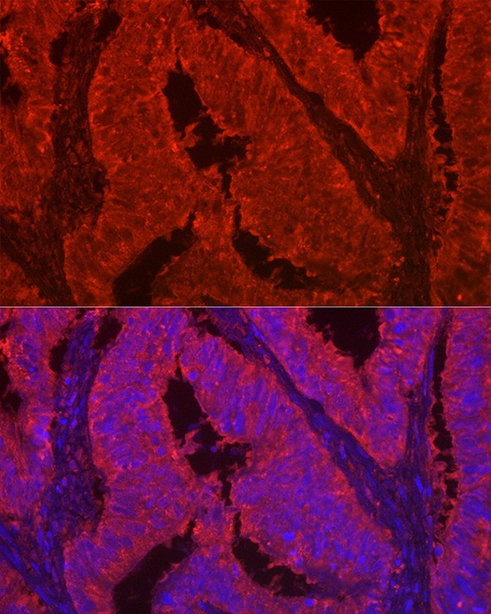 Immunofluorescence analysis of human colon carcinoma using LGALS2 Polyclonal Antibody at dilution of 1:100 (40x lens). Blue: DAPI for nuclear staining.