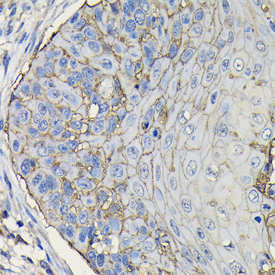 Immunohistochemistry of paraffin-embedded human esophageal cancer using TROP-2 Polyclonal Antibody at dilution of 1:100 (40x lens).Perform high pressure antigen retrieval with 10 mM citrate buffer pH 6.0 before commencing with IHC staining protocol.