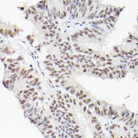 Immunohistochemistry of paraffin-embedded human colon carcinoma using LEO1 Polyclonal Antibody at dilution of 1:100 (40x lens).Perform high pressure antigen retrieval with 10 mM citrate buffer pH 6.0 before commencing with IHC staining protocol.