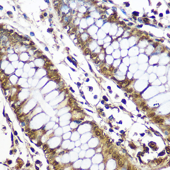 Immunohistochemistry of paraffin-embedded Human colon using CNOT7 Polyclonal Antibody at dilution of 1:50 (40x lens).Perform microwave antigen retrieval with 10 mM PBS buffer pH 7.2 before commencing with IHC staining protocol.