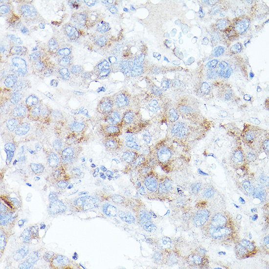 Immunohistochemistry of paraffin-embedded human liver cancer using TFR2 Polyclonal Antibody at dilution of 1:100 (40x lens).Perform high pressure antigen retrieval with 10 mM citrate buffer pH 6.0 before commencing with IHC staining protocol.