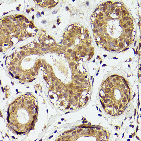 Immunohistochemistry of paraffin-embedded human breast cancer using PTEN Polyclonal Antibody at dilution of 1:50 (40x lens).Perform high pressure antigen retrieval with 10 mM citrate buffer pH 6.0 before commencing with IHC staining protocol.