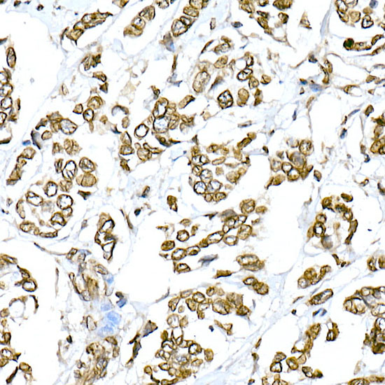 Immunohistochemistry of paraffin-embedded human breast cancer using Lamin A/C Polyclonal Antibody at dilution of 1:100 (40x lens).Perform high pressure antigen retrieval with 10 mM citrate buffer pH 6.0 before commencing with IHC staining protocol.