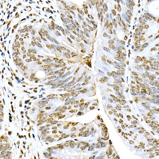 Immunohistochemistry of paraffin-embedded human colon carcinoma using Lamin A/C Polyclonal Antibody at dilution of 1:100 (40x lens).Perform high pressure antigen retrieval with 10 mM citrate buffer pH 6.0 before commencing with IHC staining protocol.