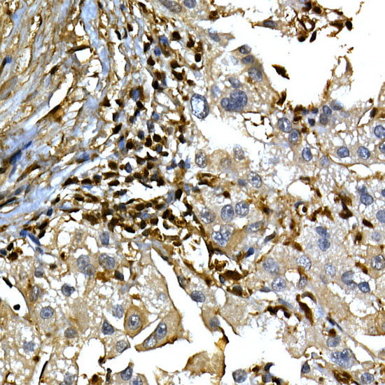 Immunohistochemistry of paraffin-embedded human liver cancer using [KO Validated] ANXA1 Polyclonal Antibody at dilution of 1:100 (40x lens).Perform high pressure antigen retrieval with 10 mM citrate buffer pH 6.0 before commencing with IHC staining protocol.