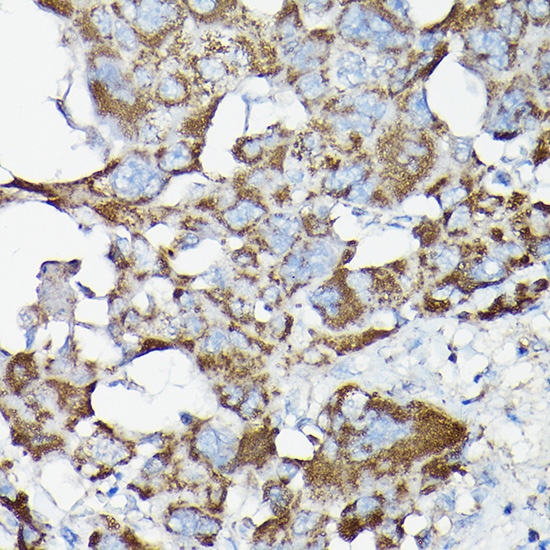 Immunohistochemistry of paraffin-embedded human liver cancer using NF-kB p65/RelA Polyclonal Antibody at dilution of 1:200 (40x lens).Perform high pressure antigen retrieval with 10 mM citrate buffer pH 6.0 before commencing with IHC staining protocol.