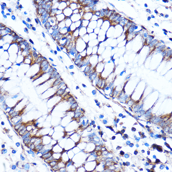 Immunohistochemistry of paraffin-embedded Human colon using CTGF Polyclonal Antibody at dilution of 1:100 (40x lens).Perform microwave antigen retrieval with 10 mM PBS buffer pH 7.2 before commencing with IHC staining protocol.