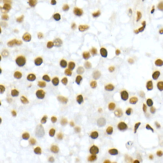 Immunohistochemistry of paraffin-embedded Human liver cancer using VDR Polyclonal Antibody at dilution of 1:100 (40x lens).Perform high pressure antigen retrieval with 10 mM citrate buffer pH 6.0 before commencing with IHC staining protocol.