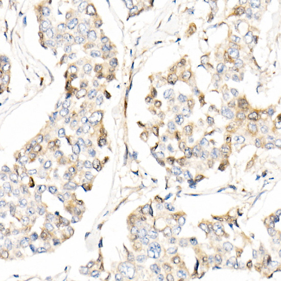 Immunohistochemistry of paraffin-embedded human breast cancer using AIFM2/AMID/AMID/AMID Polyclonal Antibody at dilution of 1:20 (40x lens).Perform high pressure antigen retrieval with 10 mM citrate buffer pH 6.0 before commencing with IHC staining protocol.