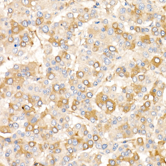 Immunohistochemistry of paraffin-embedded human liver cancer using AIFM2/AMID/AMID/AMID Polyclonal Antibody at dilution of 1:20 (40x lens).Perform high pressure antigen retrieval with 10 mM citrate buffer pH 6.0 before commencing with IHC staining protocol.