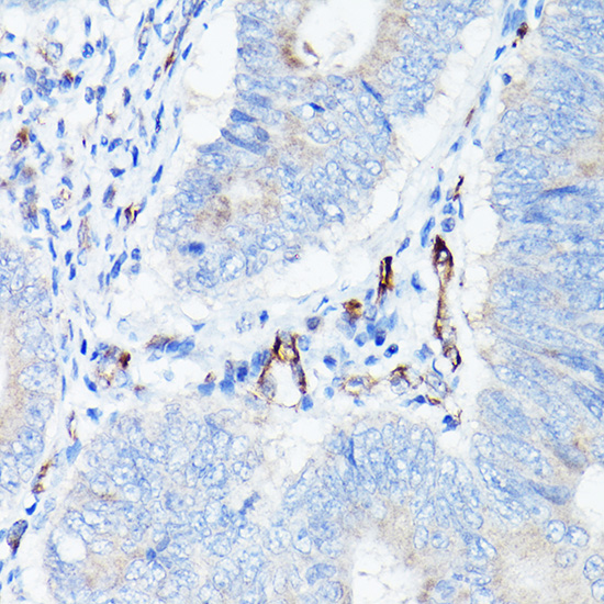 Immunohistochemistry of paraffin-embedded human colon carcinoma using VE Cadherin Polyclonal Antibody at dilution of 1:100 (40x lens).Perform high pressure antigen retrieval with 10 mM citrate buffer pH 6.0 before commencing with IHC staining protocol.