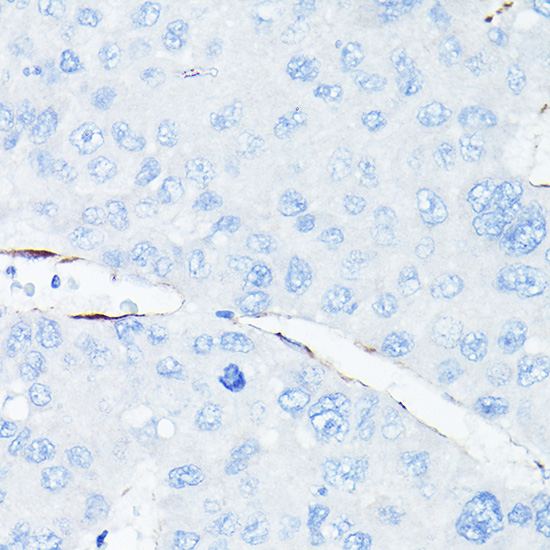 Immunohistochemistry of paraffin-embedded human liver cancer using VE Cadherin Polyclonal Antibody at dilution of 1:100 (40x lens).Perform high pressure antigen retrieval with 10 mM citrate buffer pH 6.0 before commencing with IHC staining protocol.