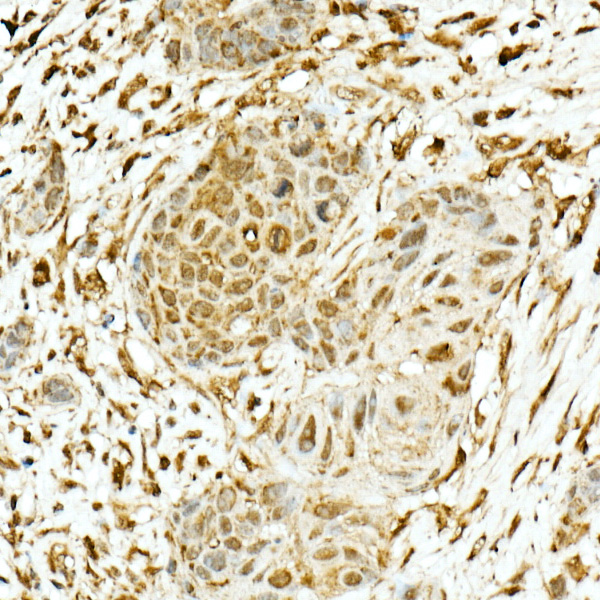 Immunohistochemistry of paraffin-embedded human esophageal cancer using NRF2 Polyclonal Antibody at dilution of 1:200 (40x lens).Perform high pressure antigen retrieval with 10 mM citrate buffer pH 6.0 before commencing with IHC staining protocol.