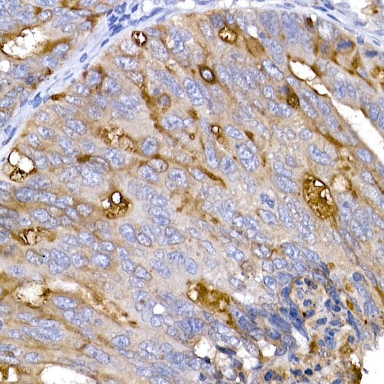 Immunohistochemistry of paraffin-embedded human colon carcinoma using ACE2 Polyclonal Antibody at dilution of 1:50 (40x lens).Perform high pressure antigen retrieval with 10 mM citrate buffer pH 6.0 before commencing with IHC staining protocol.