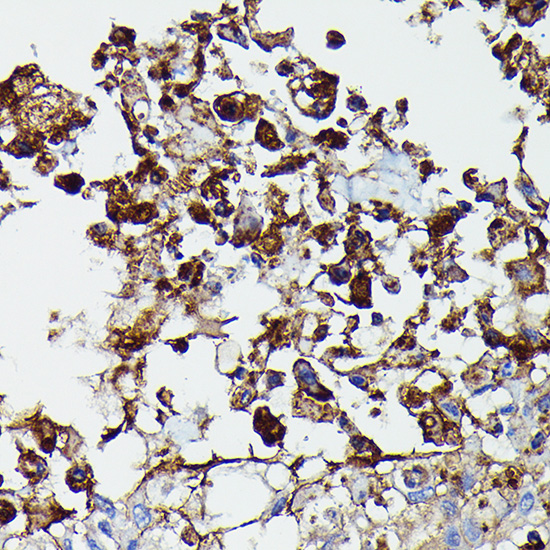 Immunohistochemistry of paraffin-embedded human lung cancer using PDGFRB Polyclonal Antibody at dilution of 1:100 (40x lens).Perform high pressure antigen retrieval with 10 mM citrate buffer pH 6.0 before commencing with IHC staining protocol.