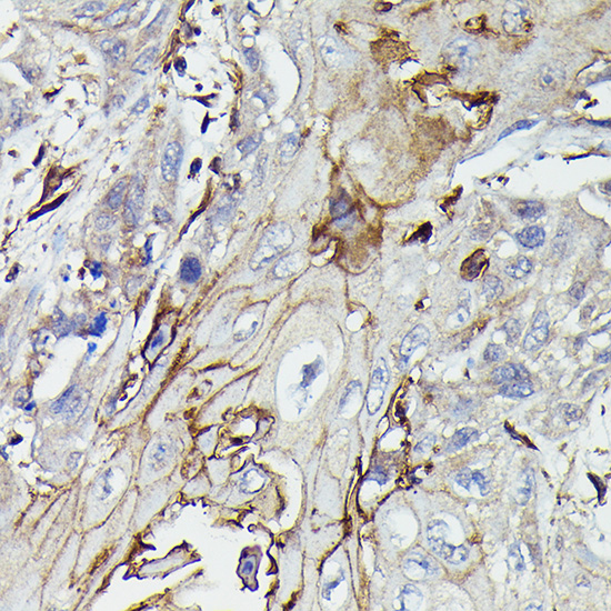 Immunohistochemistry of paraffin-embedded human esophageal cancer using PDGFRB Polyclonal Antibody at dilution of 1:100 (40x lens).Perform high pressure antigen retrieval with 10 mM citrate buffer pH 6.0 before commencing with IHC staining protocol.