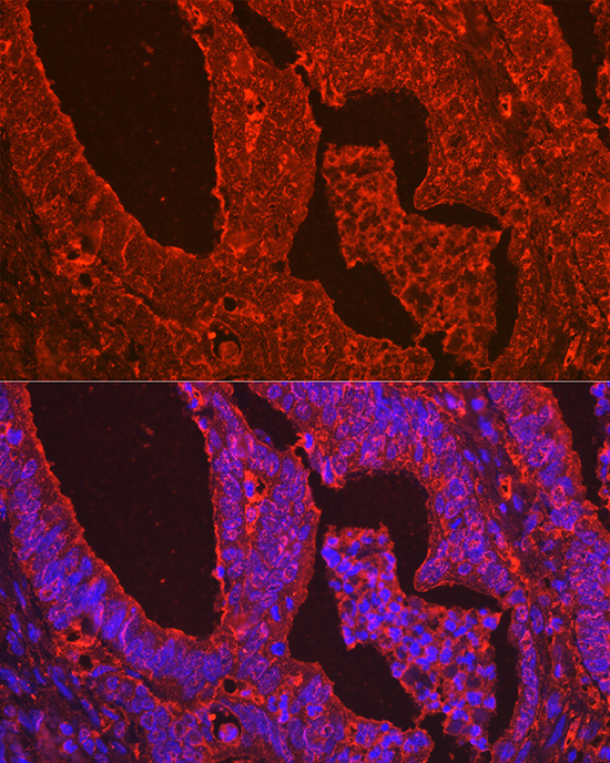 Immunofluorescence analysis of human colon carcinoma using Galectin 3/Galectin 3/LGALS3 Polyclonal Antibody at dilution of 1:100 (40x lens). Blue: DAPI for nuclear staining.