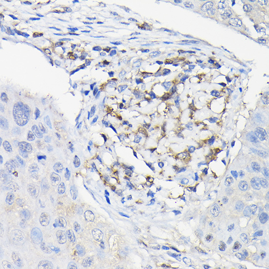 Immunohistochemistry of paraffin-embedded human esophageal cancer using Galectin 3/Galectin 3/LGALS3 Polyclonal Antibody at dilution of 1:100 (40x lens).Perform high pressure antigen retrieval with 10 mM citrate buffer pH 6.0 before commencing with IHC staining protocol.