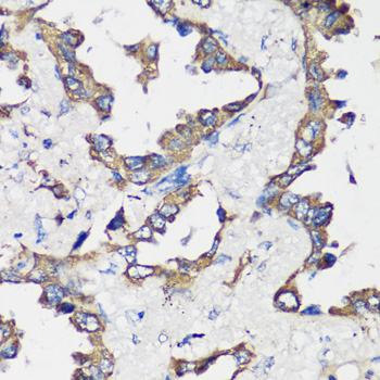 Immunohistochemistry of paraffin-embedded human lung cancer using Cyclin B1 Polyclonal Antibody at dilution of 1:100 (40x lens).Perform microwave antigen retrieval with 10 mM PBS buffer pH 7.2 before commencing with IHC staining protocol.