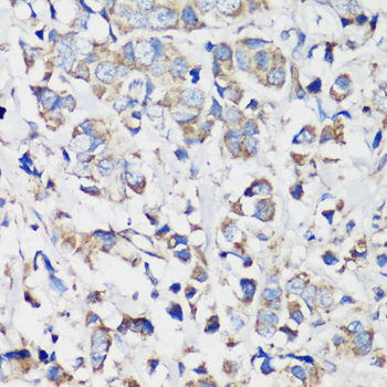 Immunohistochemistry of paraffin-embedded human breast cancer using Cyclin B1 Polyclonal Antibody at dilution of 1:100 (40x lens).Perform microwave antigen retrieval with 10 mM PBS buffer pH 7.2 before commencing with IHC staining protocol.