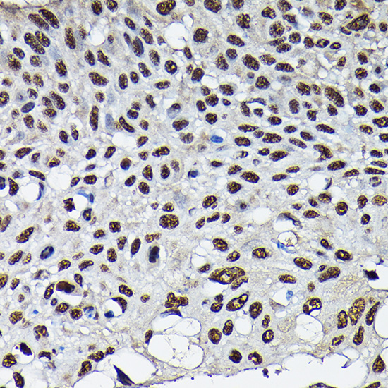 Immunohistochemistry of paraffin-embedded human lung cancer using CDK4 Polyclonal Antibody at dilution of 1:100 (40x lens).Perform high pressure antigen retrieval with 10 mM citrate buffer pH 6.0 before commencing with IHC staining protocol.