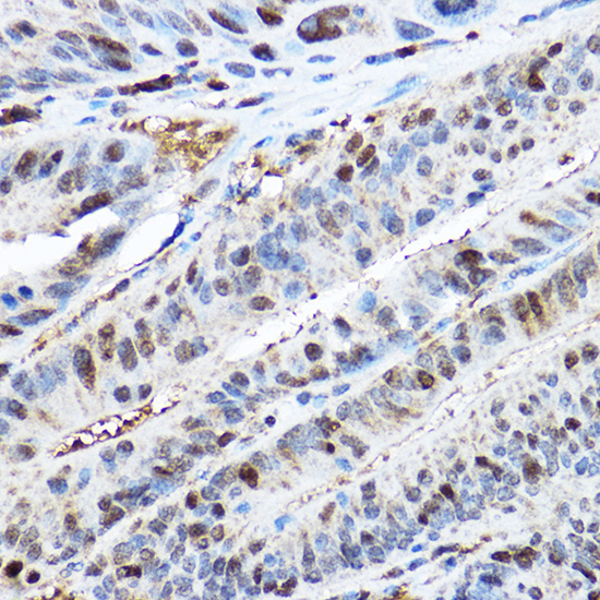 Immunohistochemistry of paraffin-embedded human colon carcinoma using CDK2 Polyclonal Antibody at dilution of 1:200 (40x lens).Perform high pressure antigen retrieval with 10 mM citrate buffer pH 6.0 before commencing with IHC staining protocol.