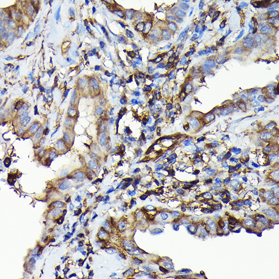 Immunohistochemistry of paraffin-embedded human thyroid cancer using MYH9 Polyclonal Antibody at dilution of 1:100 (40x lens).Perform high pressure antigen retrieval with 10 mM citrate buffer pH 6.0 before commencing with IHC staining protocol.