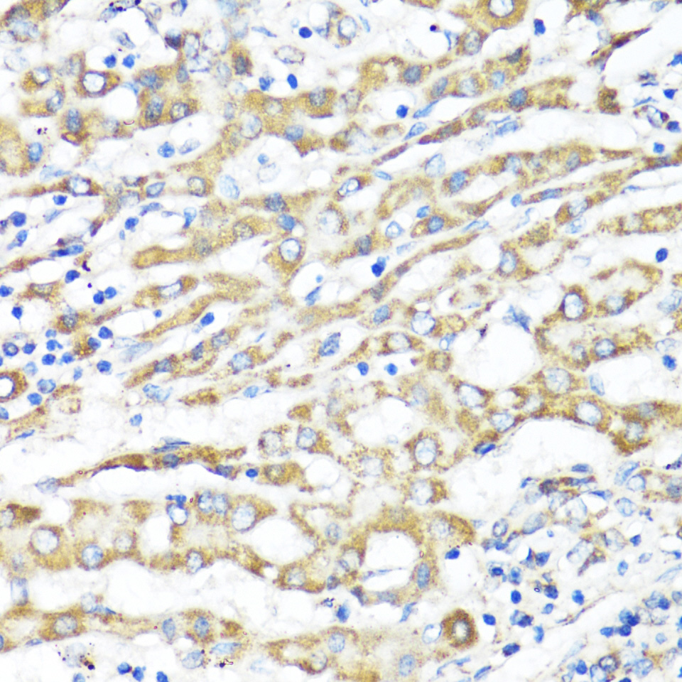 Immunohistochemistry of paraffin-embedded Hep G2 using XBP1s Polyclonal Antibody at dilution of 1:100 (40x lens).Perform microwave antigen retrieval with 10 mM PBS buffer pH 7.2 before commencing with IHC staining protocol.