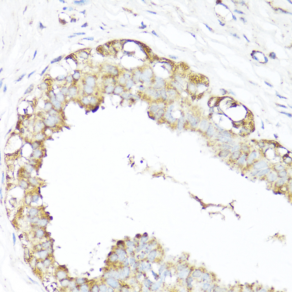 Immunohistochemistry of paraffin-embedded Human mammary cancer using XBP1s Polyclonal Antibody at dilution of 1:100 (40x lens).Perform microwave antigen retrieval with 10 mM PBS buffer pH 7.2 before commencing with IHC staining protocol.