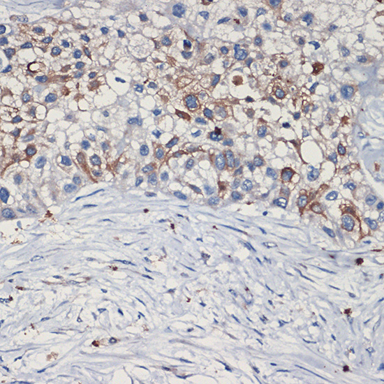 Immunohistochemistry of paraffin-embedded human lung cancer using MET Polyclonal Antibody at dilution of 1:100 (40x lens).Perform high pressure antigen retrieval with 10 mM citrate buffer pH 6.0 before commencing with IHC staining protocol.