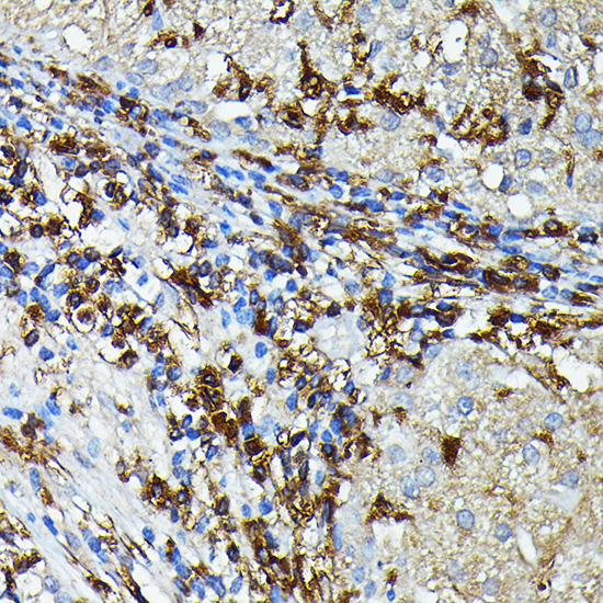 Immunohistochemistry of paraffin-embedded Human liver cancer using HLA-DPB1 Polyclonal Antibody at dilution of 1:100 (40x lens).Perform high pressure antigen retrieval with 10 mM citrate buffer pH 6.0 before commencing with IHC staining protocol.