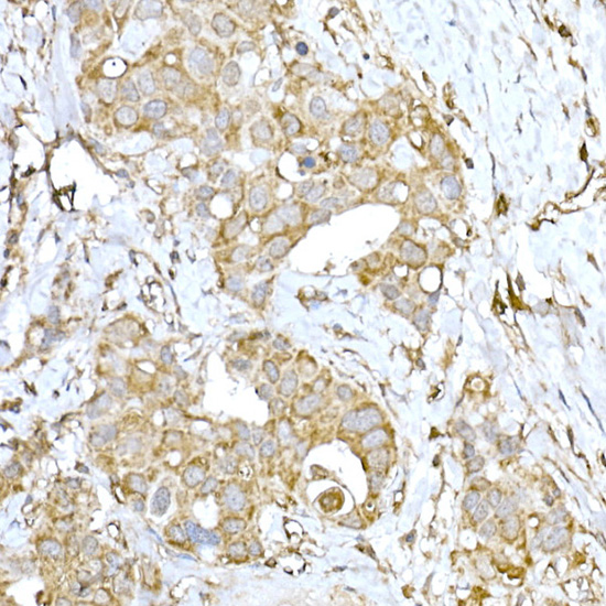 Immunohistochemistry of paraffin-embedded human breast cancer using IRE1 Polyclonal Antibody at dilution of 1:100 (40x lens).Perform high pressure antigen retrieval with 10 mM citrate buffer pH 6.0 before commencing with IHC staining protocol.