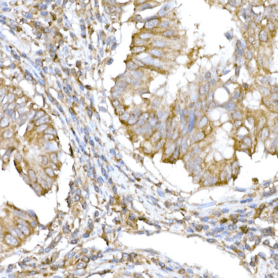 Immunohistochemistry of paraffin-embedded human colon carcinoma using IRE1 Polyclonal Antibody at dilution of 1:100 (40x lens).Perform high pressure antigen retrieval with 10 mM citrate buffer pH 6.0 before commencing with IHC staining protocol.