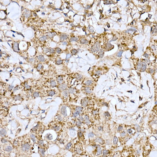Immunohistochemistry of paraffin-embedded human breast cancer using MT-ND6 Polyclonal Antibody at dilution of 1:100 (40x lens).Perform high pressure antigen retrieval with 10 mM citrate buffer pH 6.0 before commencing with IHC staining protocol.