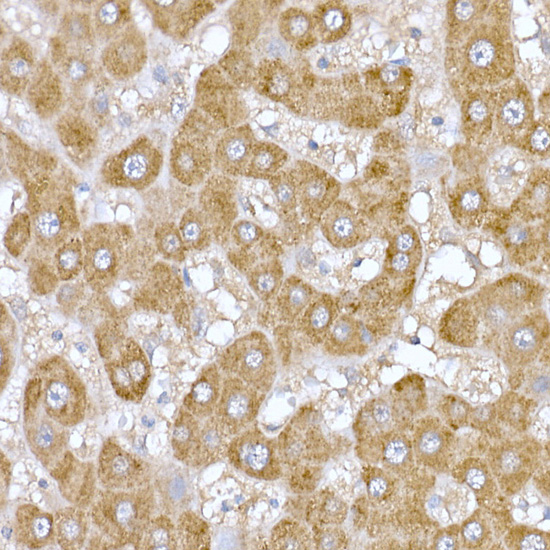 Immunohistochemistry of paraffin-embedded human liver using MT-ND6 Polyclonal Antibody at dilution of 1:100 (40x lens).Perform high pressure antigen retrieval with 10 mM citrate buffer pH 6.0 before commencing with IHC staining protocol.