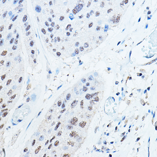 Immunohistochemistry of paraffin-embedded human esophageal cancer using Ubiquitin Polyclonal Antibody at dilution of 1:100 (40x lens).Perform high pressure antigen retrieval with 10 mM citrate buffer pH 6.0 before commencing with IHC staining protocol.