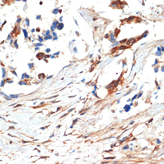 Immunohistochemistry of paraffin-embedded human lung cancer using JNK1/2/3 Polyclonal Antibody at dilution of 1:100 (40x lens).Perform microwave antigen retrieval with 10 mM Tris/EDTA buffer pH 9.0 before commencing with IHC staining protocol.